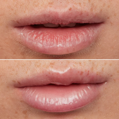 Lip Rehab Therapy Oil
